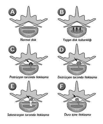 Bel Fıtığı Gelişim